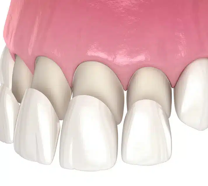 Dental Veneers – Transforming Smiles with Style
