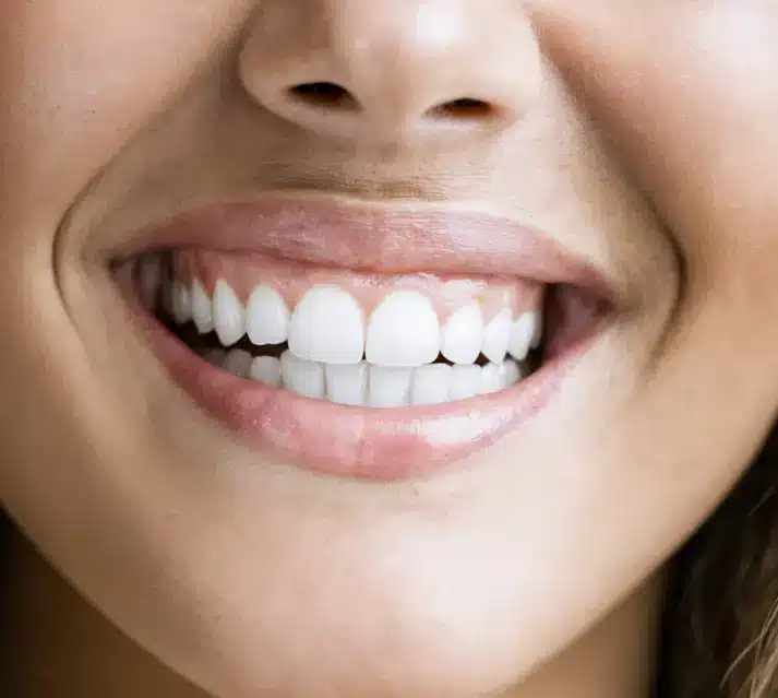How Whitening Shades Influence the Aesthetic Impact of Your Smile