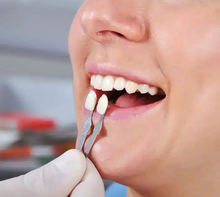 Porcelain Veneers vs. Latest-Generation Composites