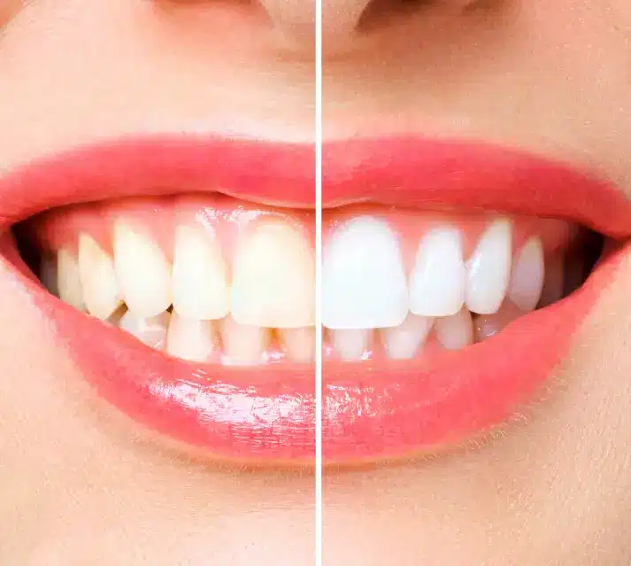 Teeth Whitening
