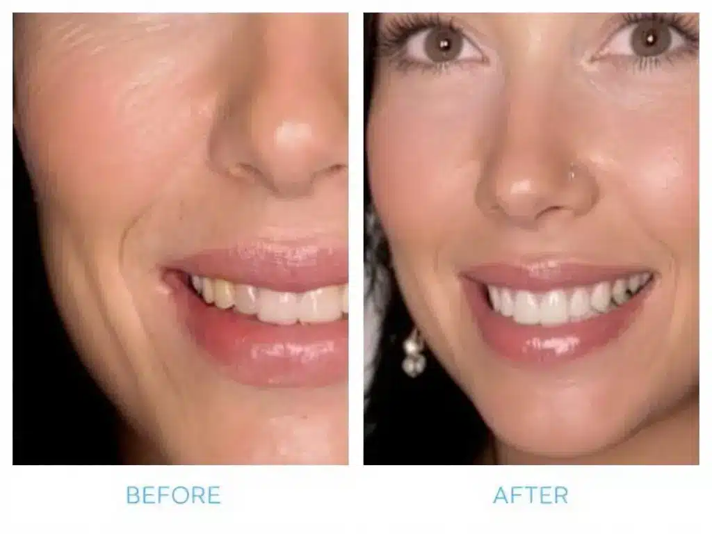 The Gum Contouring Procedure