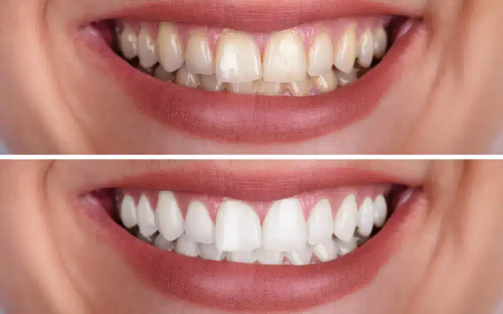 What is Teeth Whitening