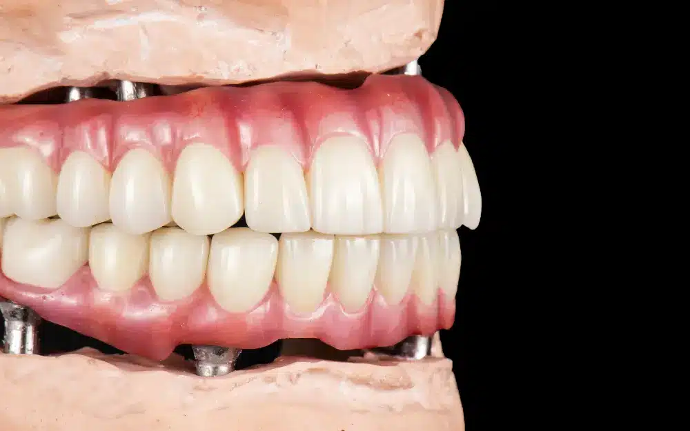 Is Zygomatic Implant Surgery Right for You