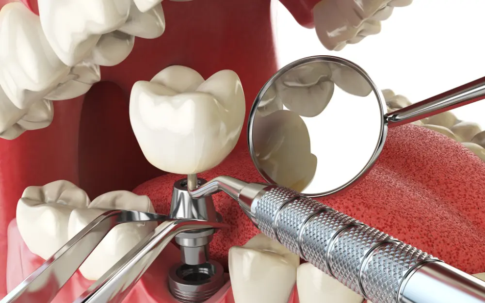 What materials are used in dental implants
