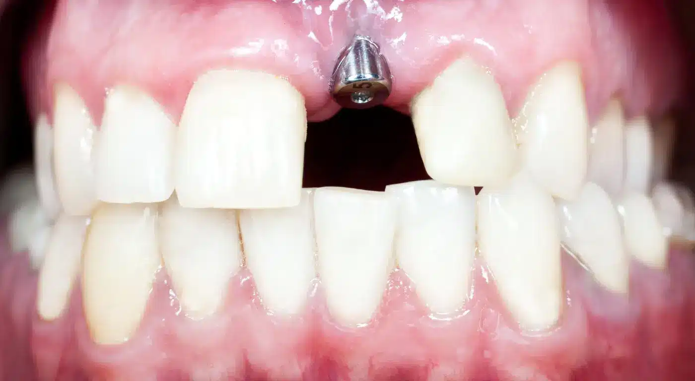 Best Practices for Implant Success in Teenagers