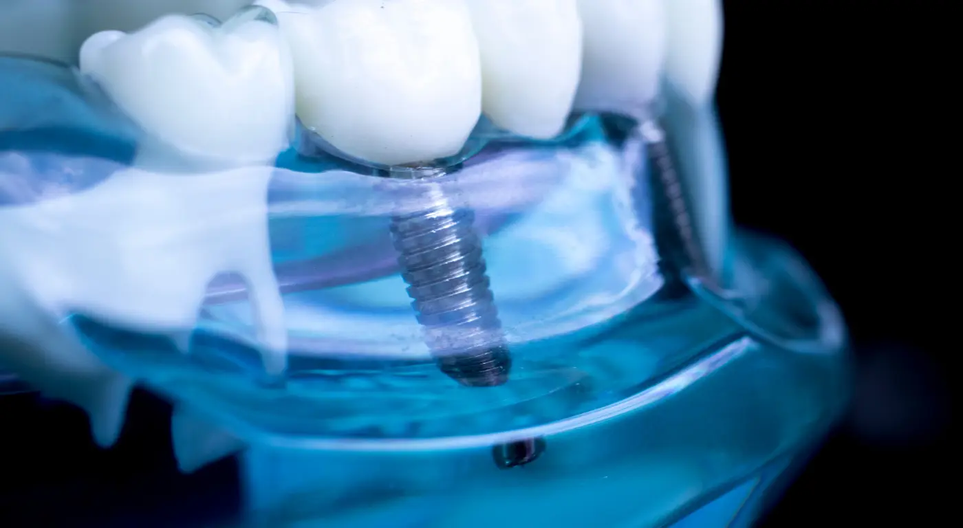 Future Trends in Teen Dental Implants After Sports Injuries