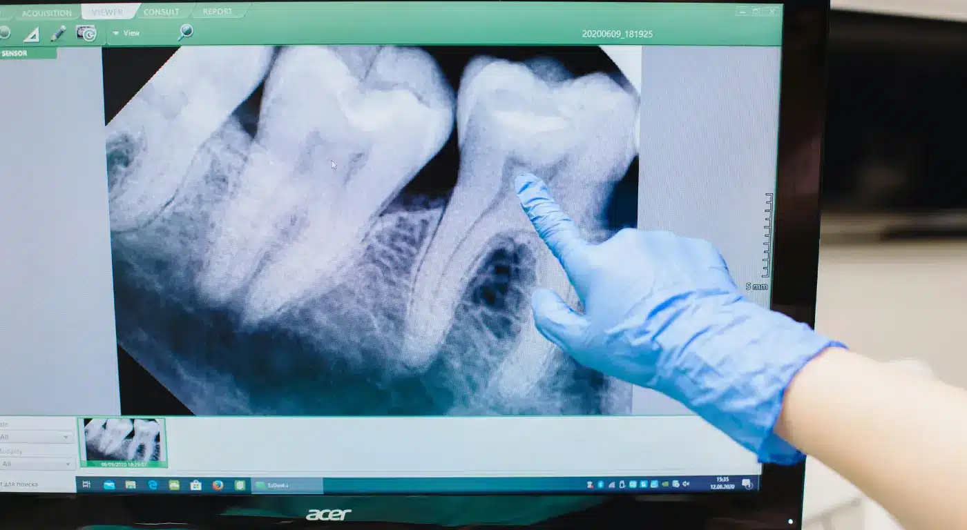 The Wisdom Tooth Removal Procedure